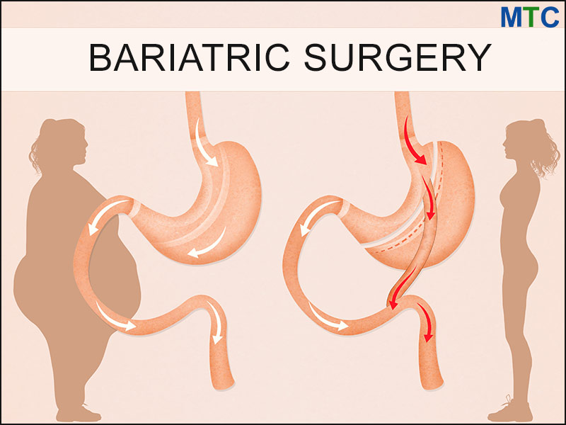 American Society For Metabolic And Bariatric Surgery