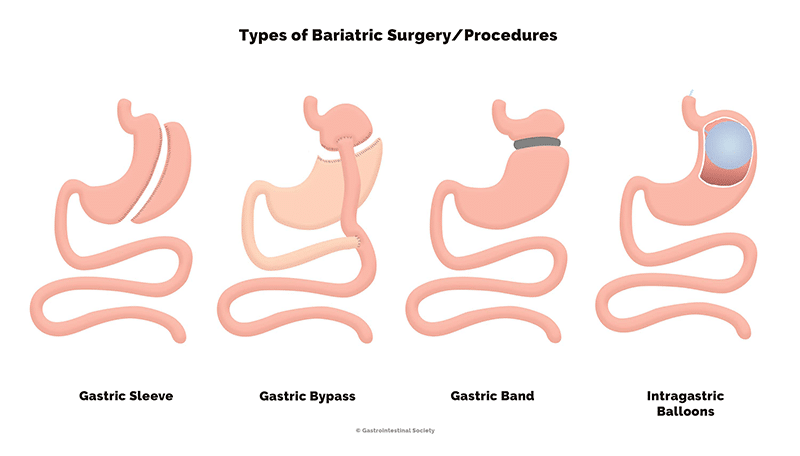Bariatric Procedure